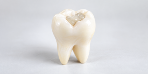 Tooth-colored filling illustration